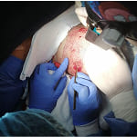 Procedimiento de implante capilar con sedación ambulatoria en Colombia