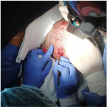 Sedación intravenosa en procedimientos de implante capilar en Colombia